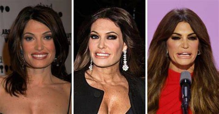 Kimberly Guilfoyle's Transformation: A Before And After Botox Comparison